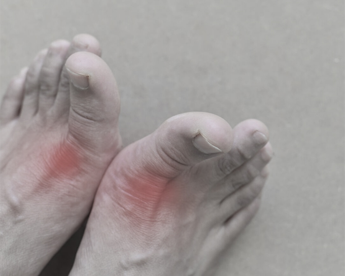 Ankylosing Spondylitis Arthritis Treatment in Calicut Kerala