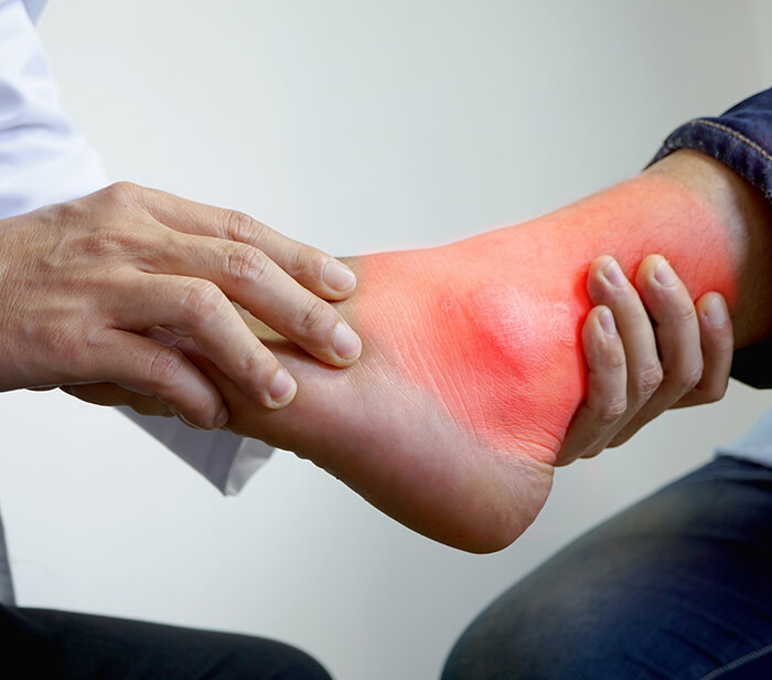 Gouty Arthritis Treatment in Calicut Kerala