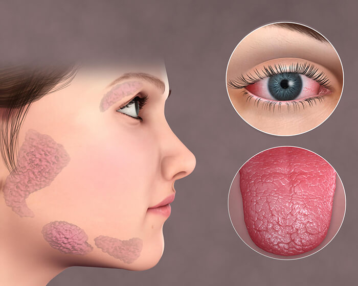 Sjogren’s Syndrome Treatment in Calicut Kerala
