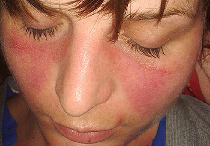 Systemic Lupus Erythematosus (SLE) Treatment in Calicut Kerala