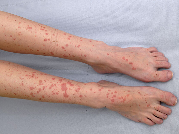 Vasculitis Treatment in Calicut Kerala